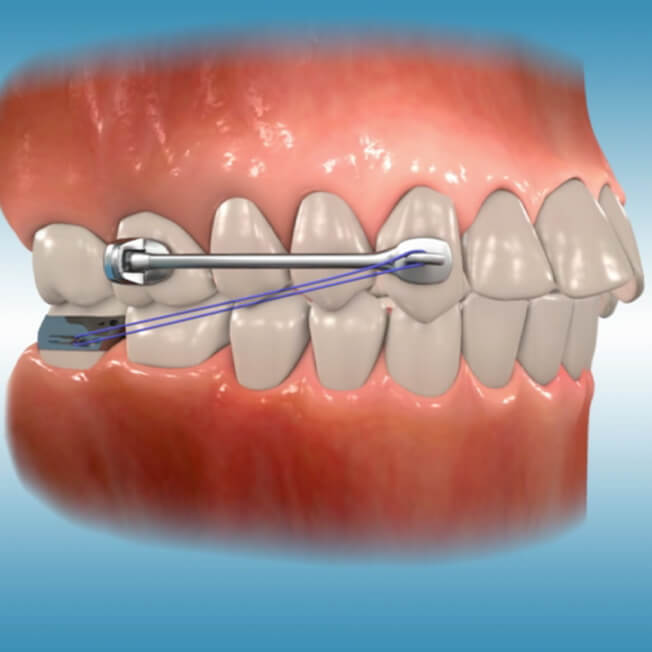 How does the Carriere Motion Appliance work?