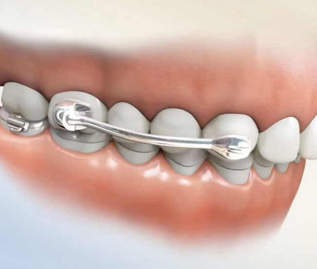  Benefits of functional braces