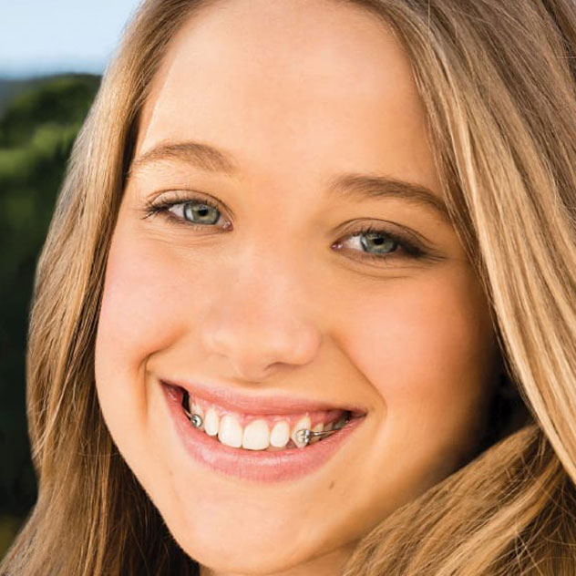 Benefits of the Carriere Motion Appliance