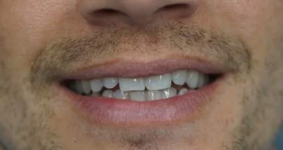 Teeth Before