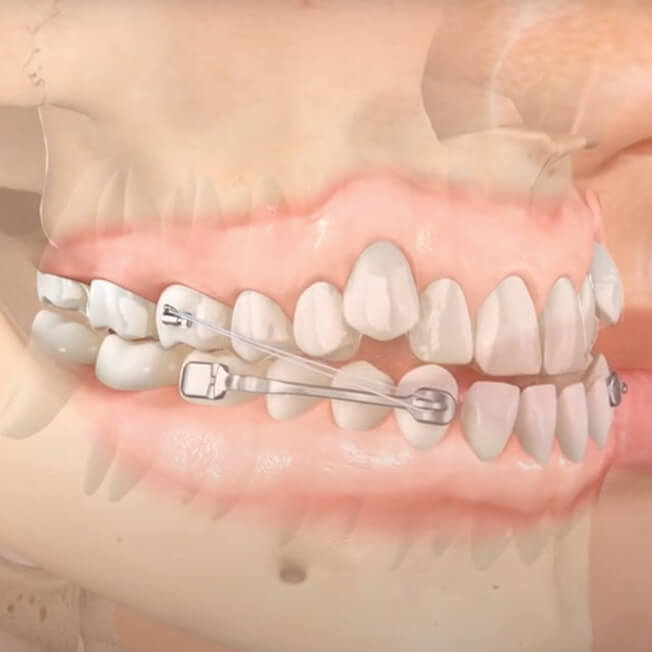 Carriere Motion Appliance