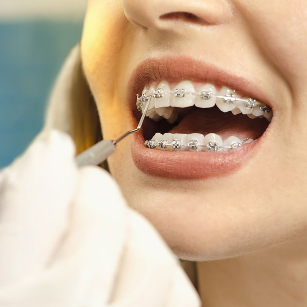 Loose brackets, wires or bands