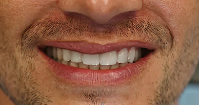 Teeth After