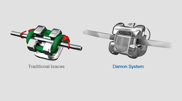 Self-Ligating Braces: Less Need For Extractions and More Comfortable Treatment