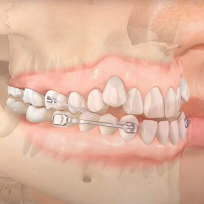 Carriere Motion Appliance