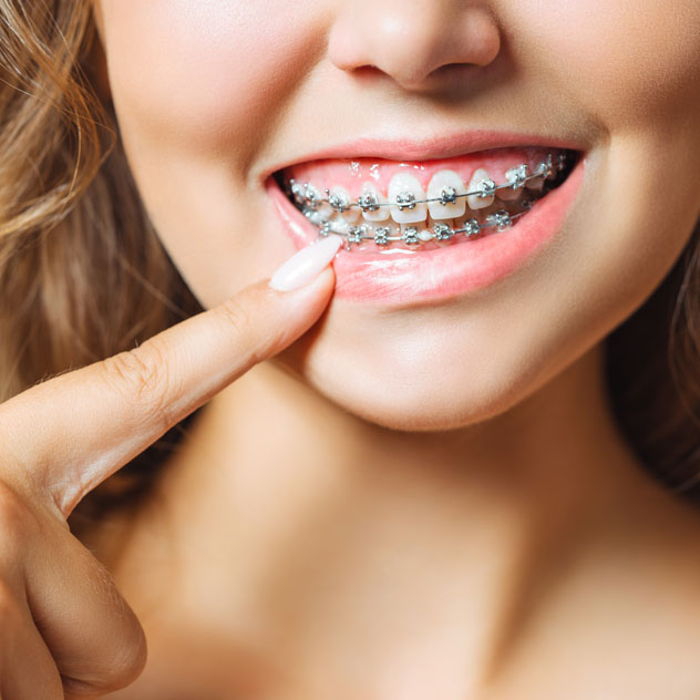 How do self-ligating braces work?