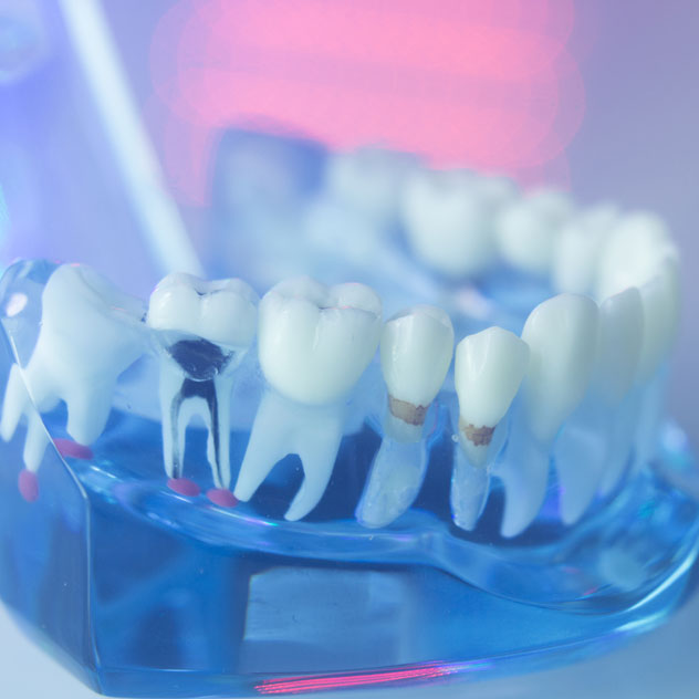 Root canal treatment