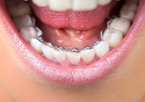 Hidden Lingual Braces